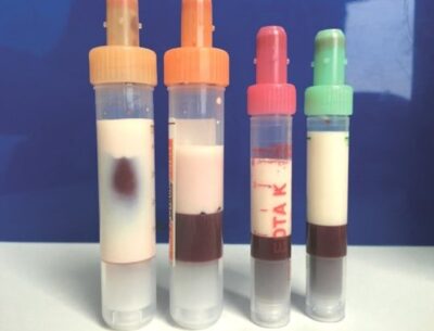 The Strange Case Of a Man Whose Blood Turned White