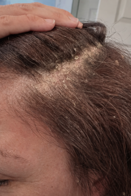 Caspa con mal olor: qué revela realmente sobre la salud de tu cuero cabelludo