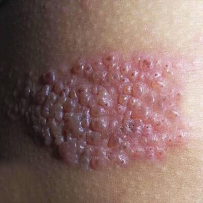 Lo que pocos saben sobre esta enfermedad silenciosa que puede aparecer sin aviso