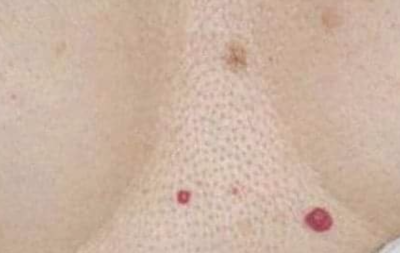 ¿Tienes estos puntos rojos en alguna zona de tu cuerpo? debes saber esto.