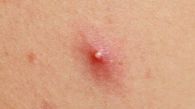 Alerta en peluquerías: una infección común tras un corte de cabello y cómo prevenirla