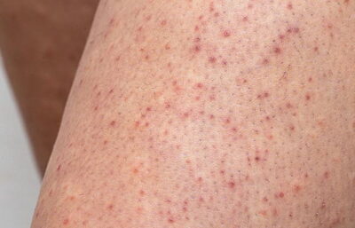 Por qué aparecen los puntitos ásperos en la piel y cómo mejorar su aspecto